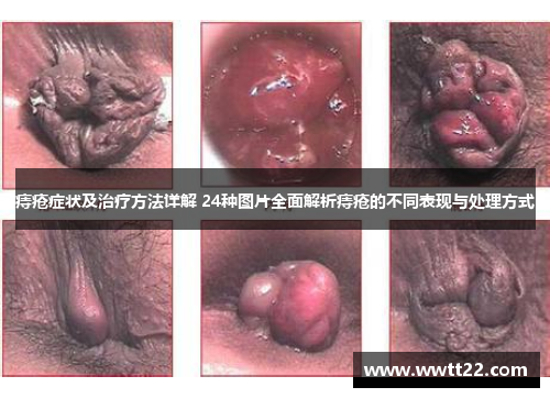 痔疮症状及治疗方法详解 24种图片全面解析痔疮的不同表现与处理方式 痔疮症状及治疗方法详解 24种图片全面解析痔疮的不同表现与处理方式