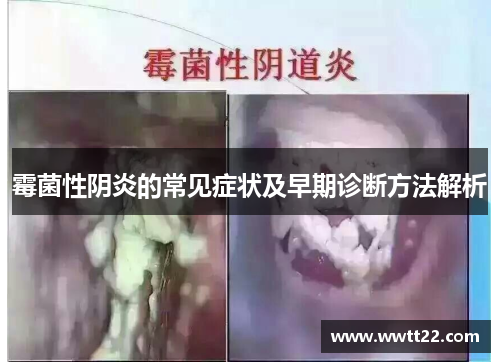 霉菌性阴炎的常见症状及早期诊断方法解析 霉菌性阴炎的常见症状及早期诊断方法解析