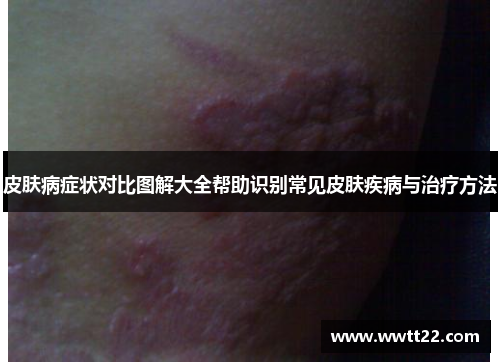 皮肤病症状对比图解大全帮助识别常见皮肤疾病与治疗方法 皮肤病症状对比图解大全帮助识别常见皮肤疾病与治疗方法